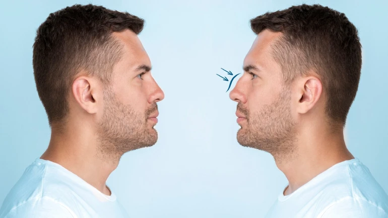 Rhinoplasty Recovery: Day-by-Day Swelling, Healing & What to Expect