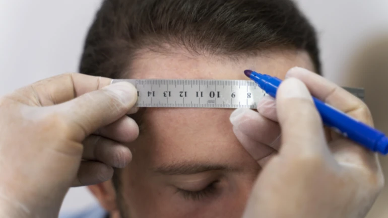 Hair Transplant Timeline: Stages of Growth, Recovery & Final Results