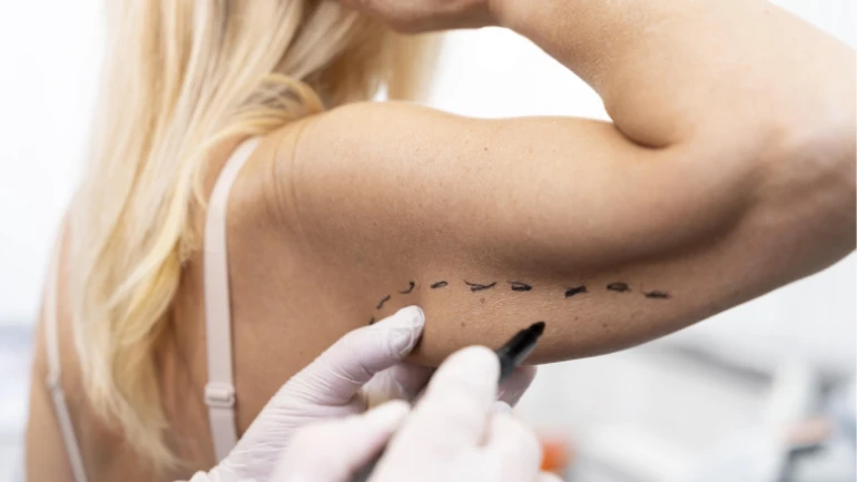 Brachioplasty Recovery: What to Expect After Arm Lift Surgery