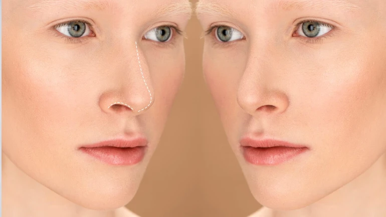 Functional Nose Surgery: Types, How They Work & Who They Help