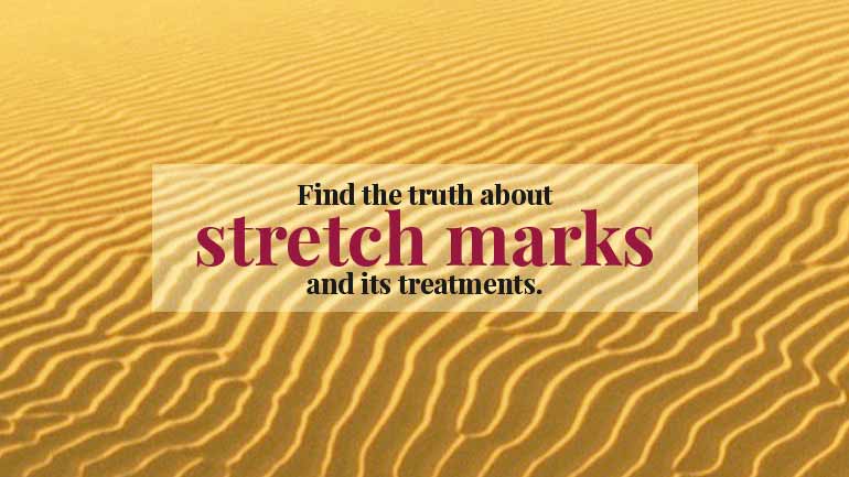 Treatments For Stretch Marks