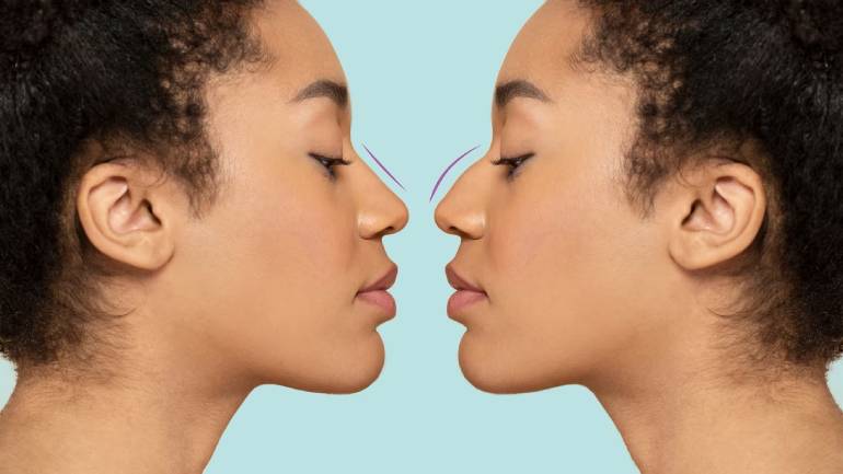 Ethnic Rhinoplasty