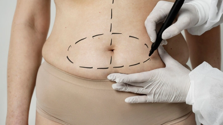 Everything You Need To Know About Tummy Tuck Surgery
