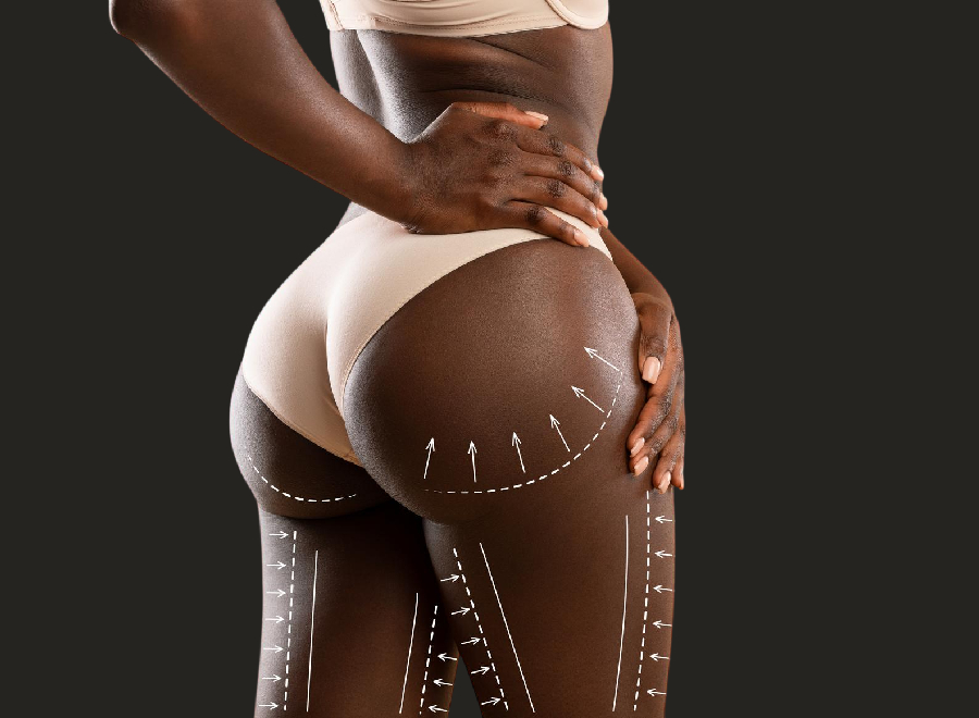 Brazilian Butt Lift (BBL) in Mumbai