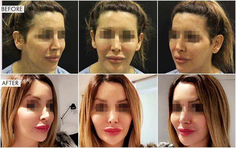 V-line Jaw Surgery