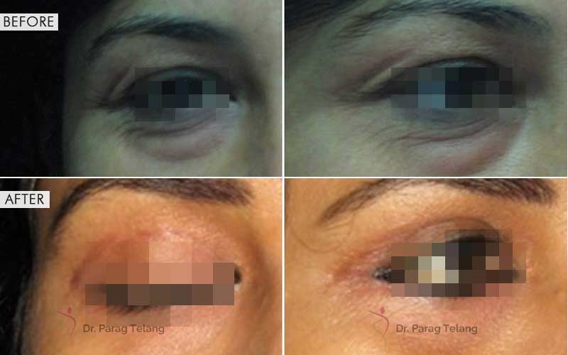 Blepharoplasty Surgery