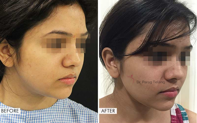 Buccal Fat