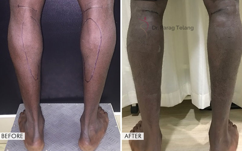 Calf Implant
