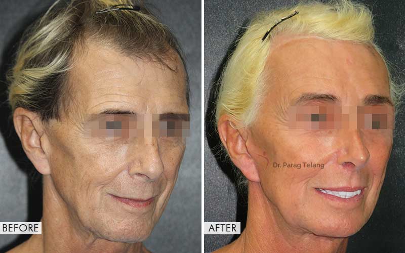 Facial Feminisation Surgery