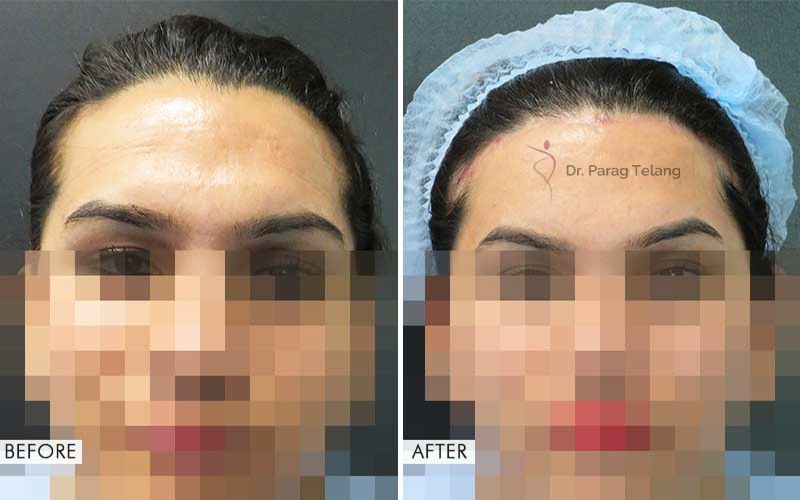 Type-3 Forehead Contouring (Brow Bone Reduction)