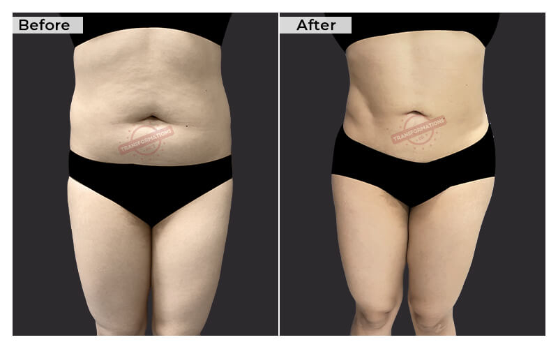 Tummy Tuck Before and After result