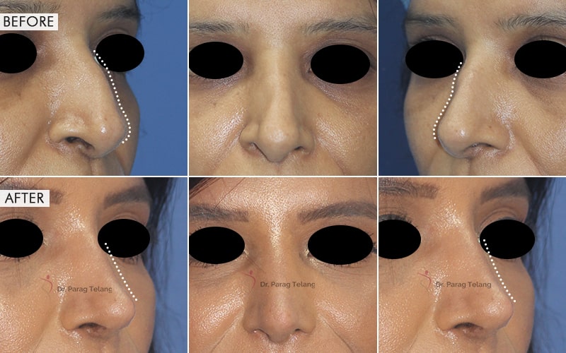 Rhinoplasty Surgery Before and After result