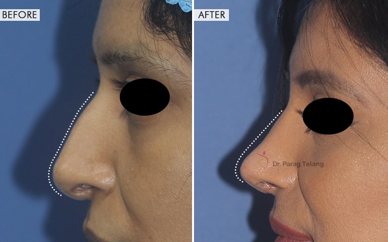 Rhinoplasty Surgery Before and After result