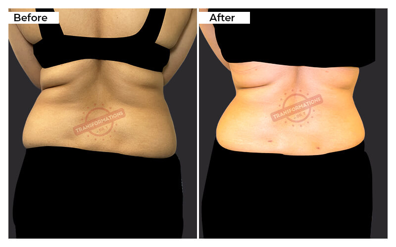 Tummy Tuck Before and After result