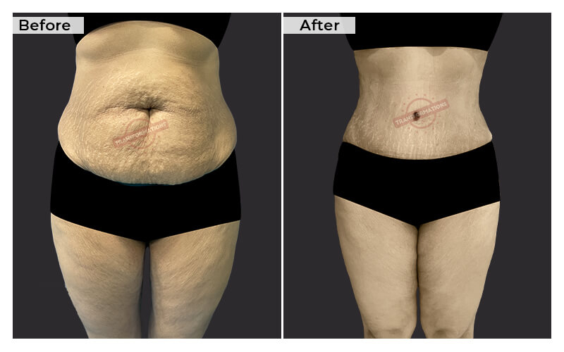 Tummy Tuck Before and After result