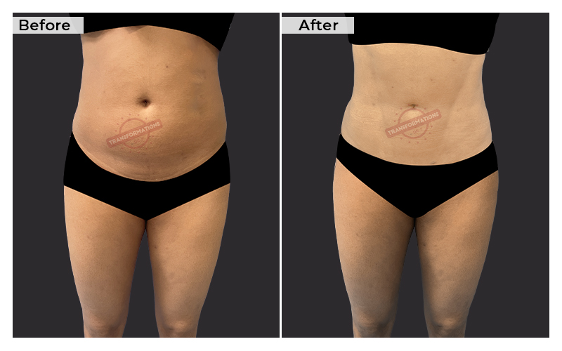 Liposuction Results - Before and After