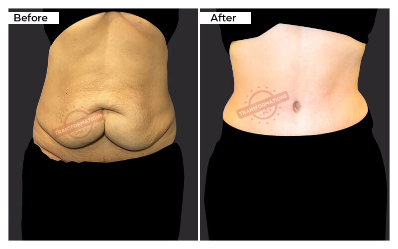 Tummy Tuck Before and After result