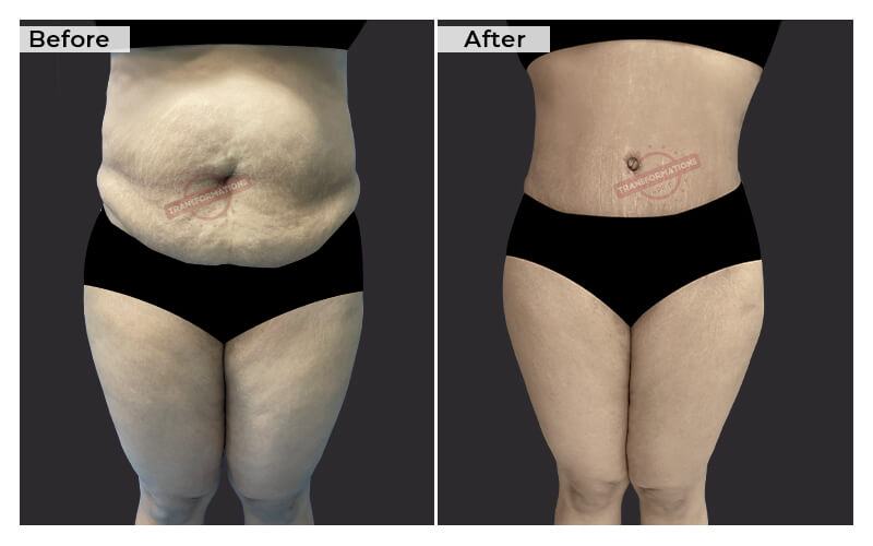 Tummy Tuck Before and After result