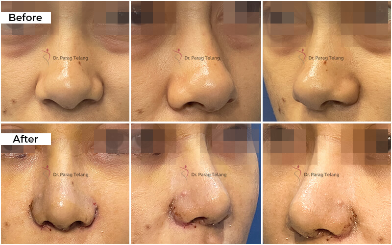 Tummy Tuck Before and After result