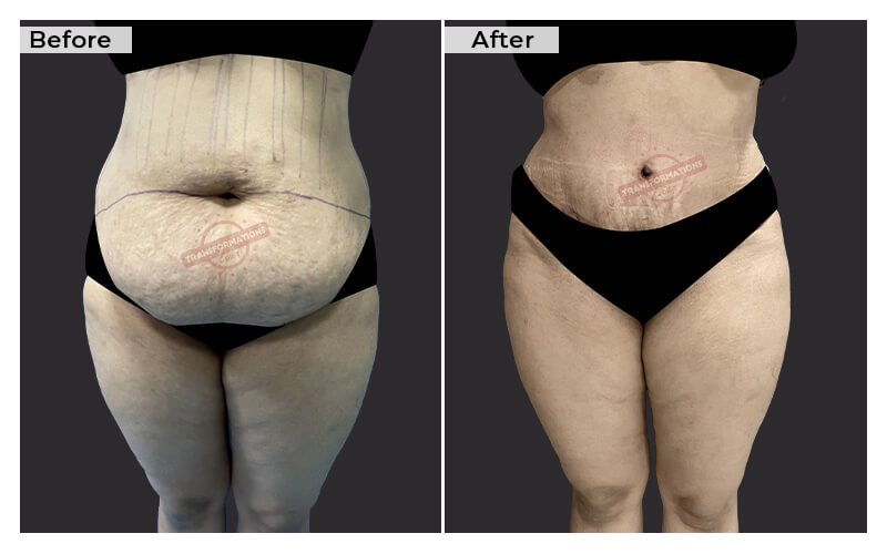 Tummy Tuck Before and After result