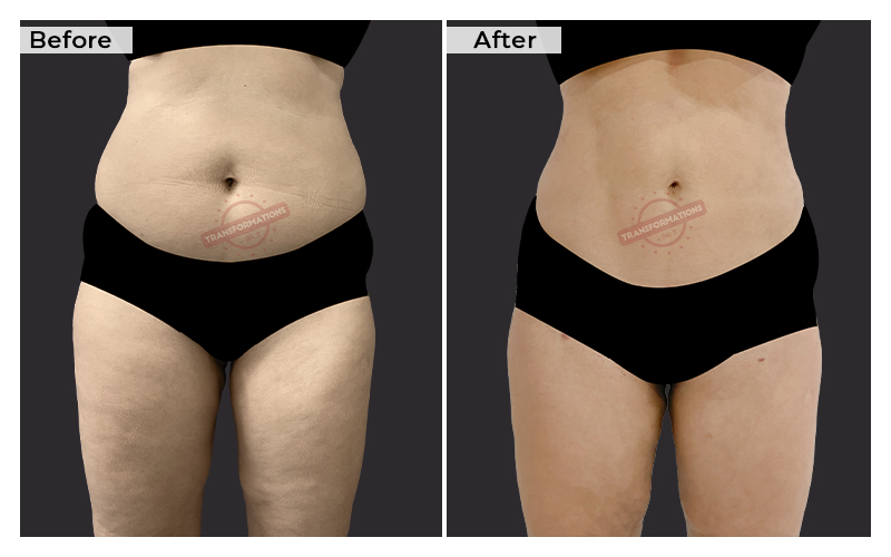 Tummy Tuck Before and After result