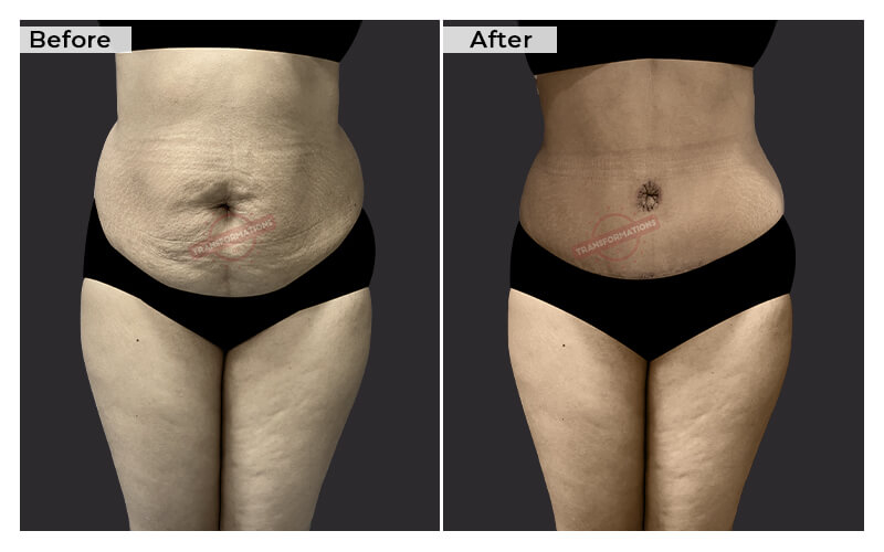 Tummy Tuck Before and After result