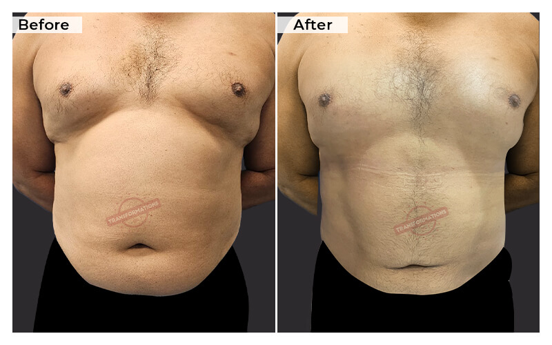 Tummy Tuck Before and After result