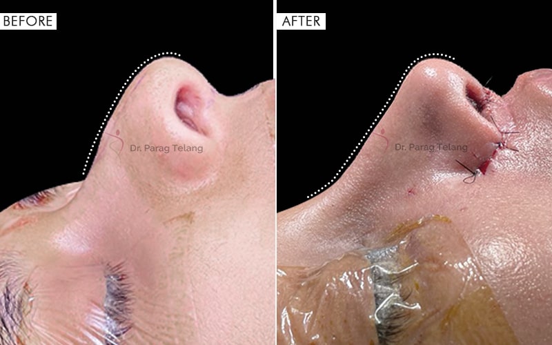 Rhinoplasty Surgery Before and After result
