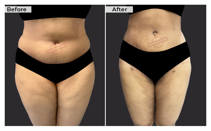 Tummy Tuck Before and After result