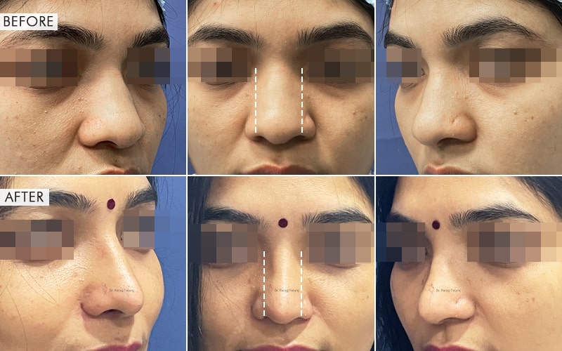 Rhinoplasty Surgery Before and After result