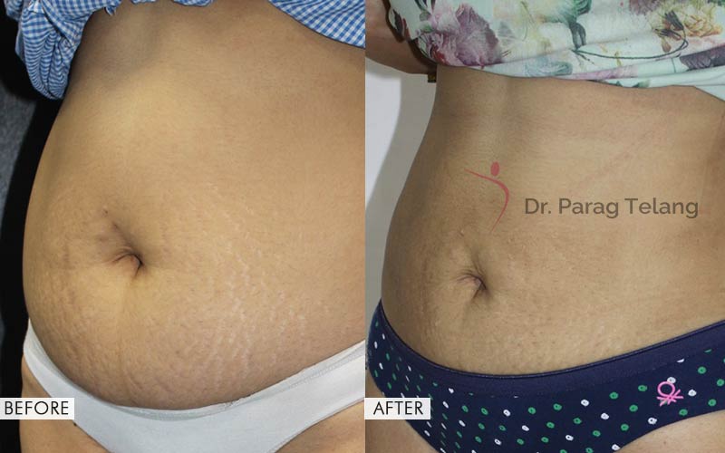 Body Contouring Before and After result