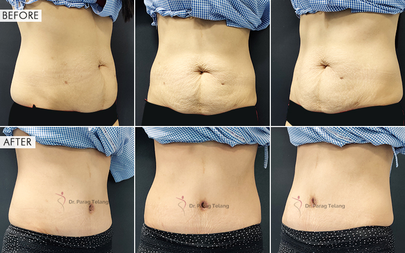 abdominoplasty surgery before and after