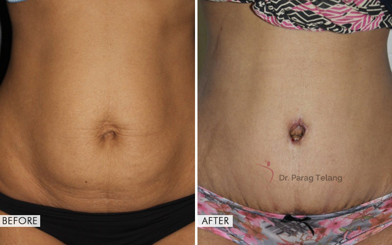 abdominoplasty before and after