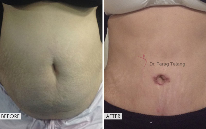 abdominoplasty before and after