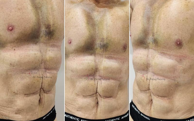 Liposuction Before and After result