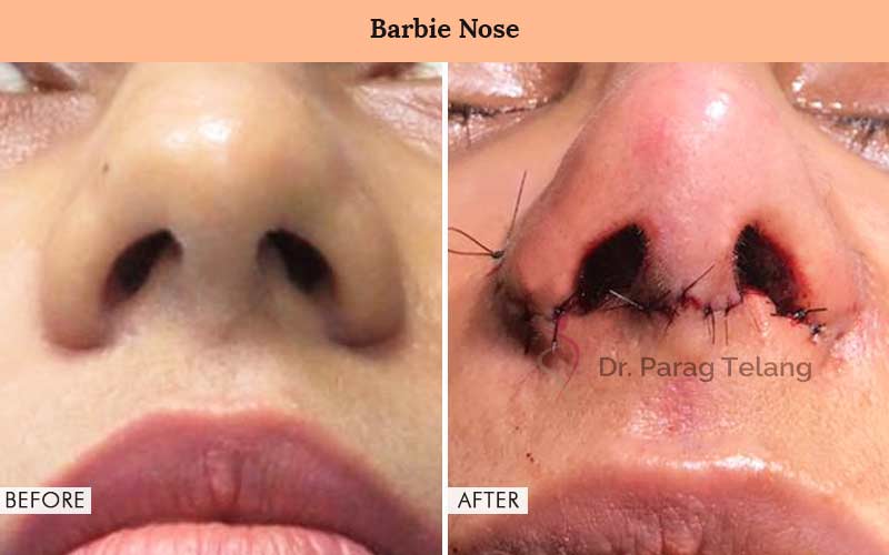 Barbie Nose Before and After