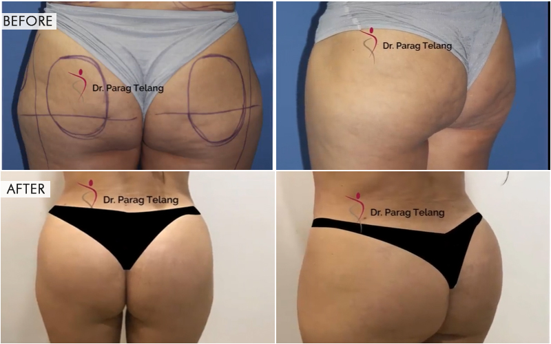 Butt Augmentation Before and After result