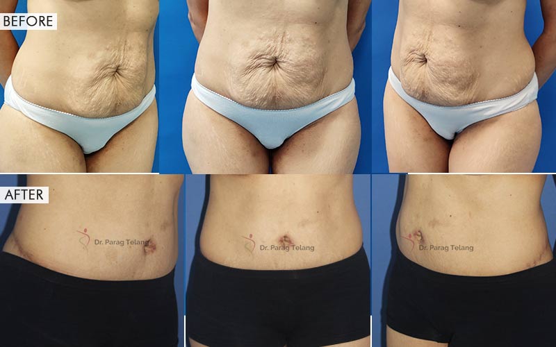 Belt Lipectomy Surgery Before After