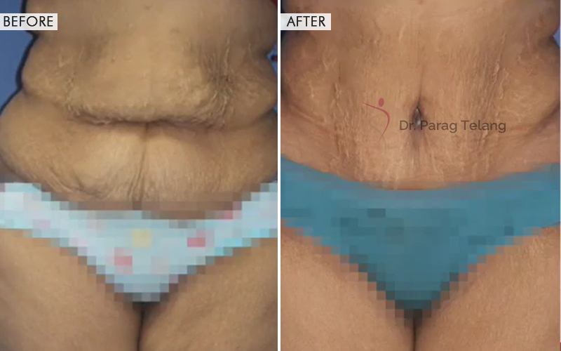 Body Contouring Before and After result