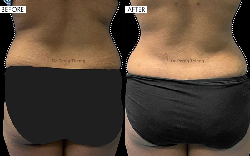 Body Contouring Before and After result