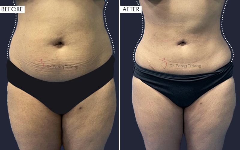 Body Contouring Before and After result