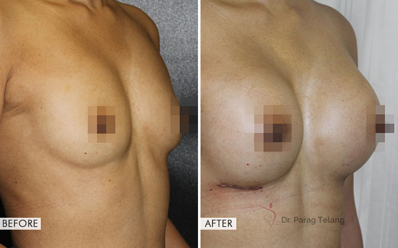 Breast Augmentation Surgery Before After