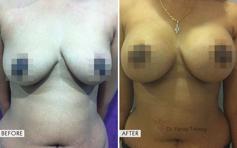 Breast Augmentation Surgery Before After
