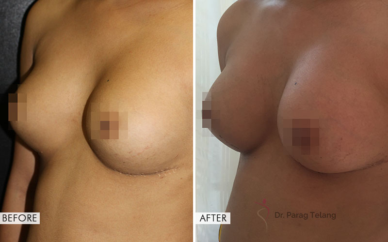 breast augmentation before and after