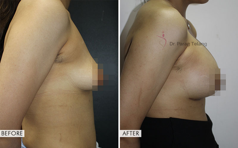 Breast Augmentation after surgery