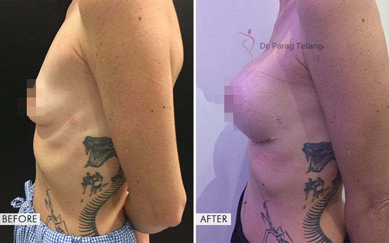 breast augmentation before and after results