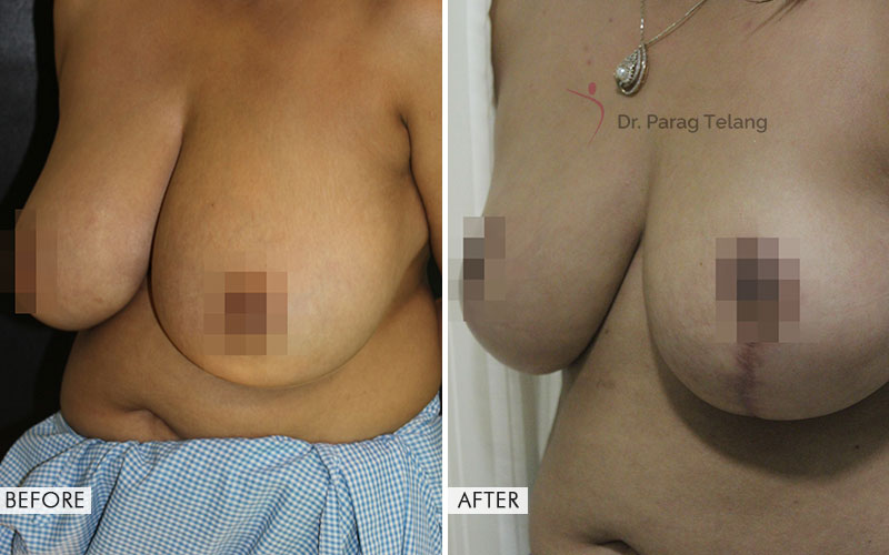 breast augmentation before and after