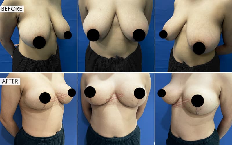 Breast Reduction Before and After result