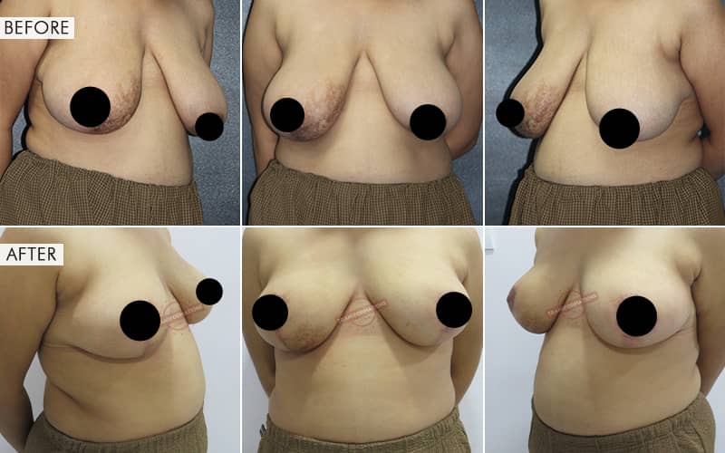 Breast Reduction Before and After result