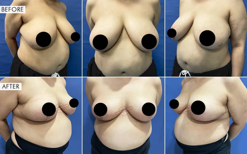 Breast Reduction Before and After result